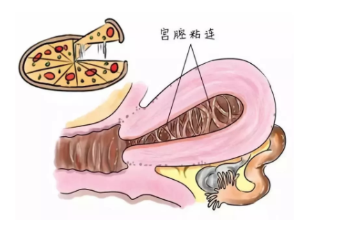 30岁做试管婴儿成功率有多少?